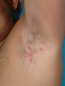 laser hair removal is needed for underarm cysts