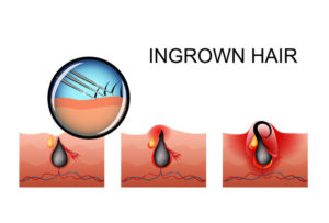 Ingrown Hairs