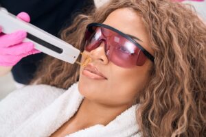 dark skin laser hair removal