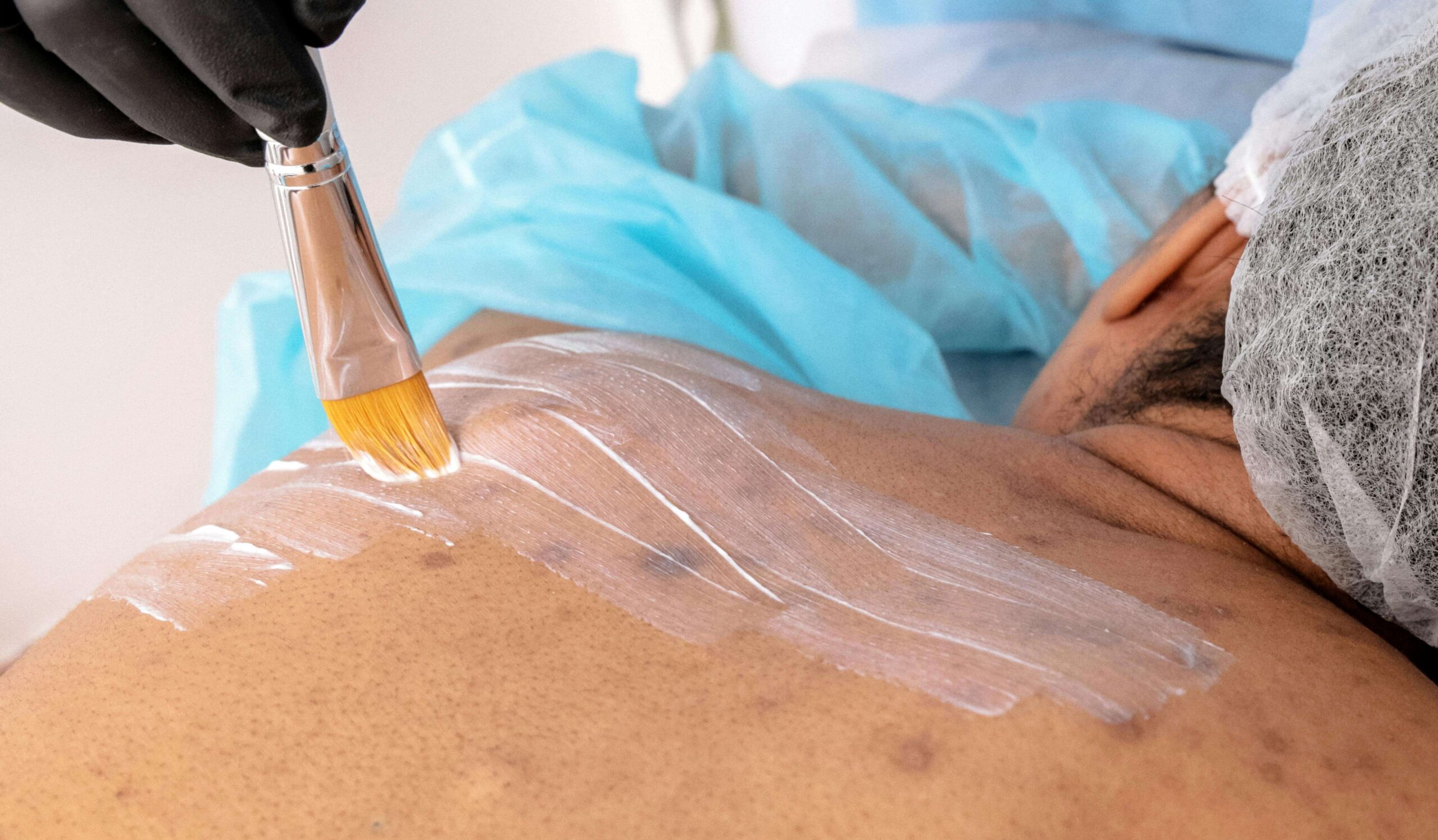 Hyperpigmentation and laser hair removal