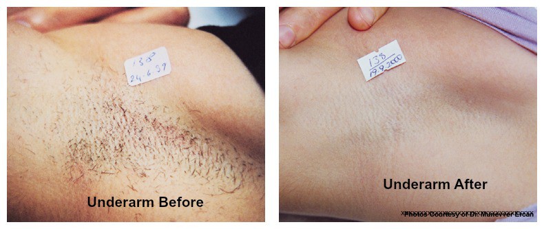 laser hair removal underarm before and after