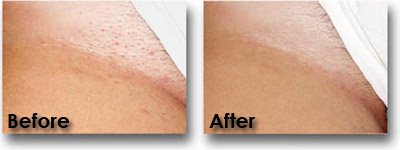 Before After Laser Hair Removal Photos Laser Affair