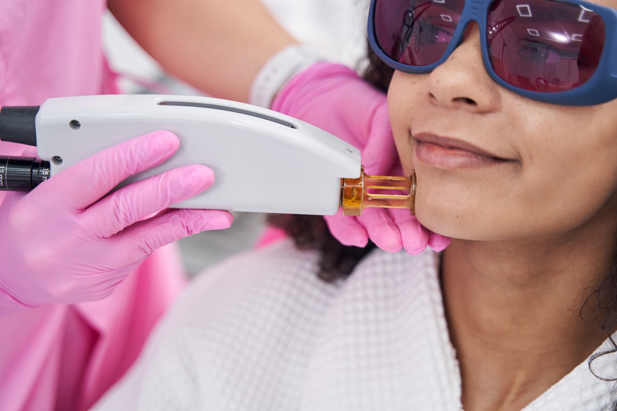 Sideburn laser hair removal at Laser Affair in Tampa
