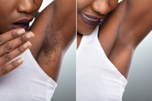 benefits of laser hair removal