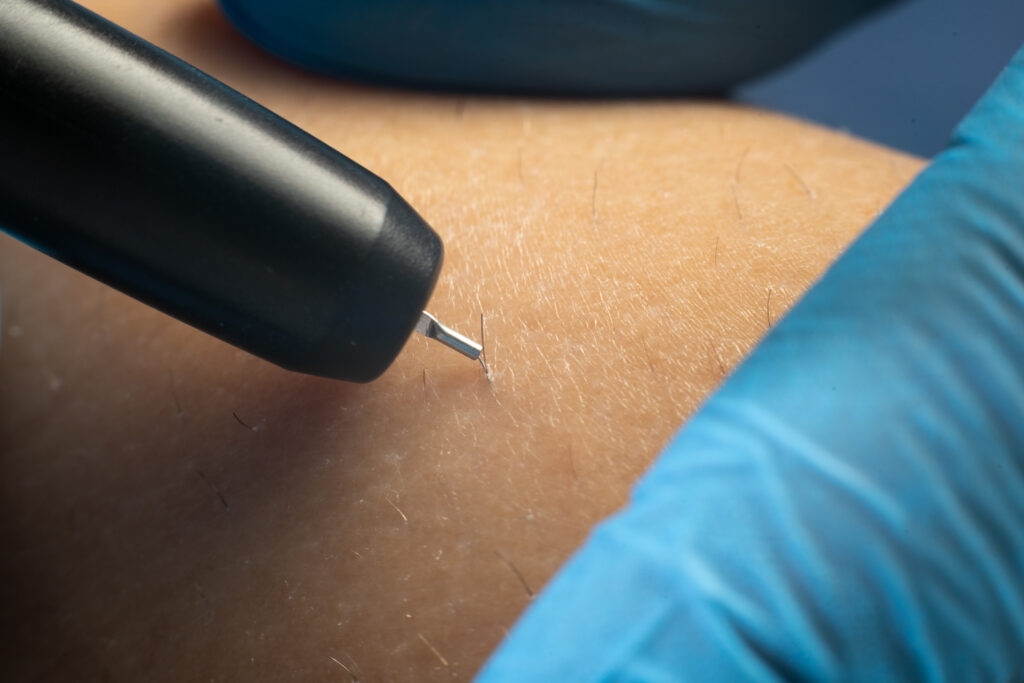 process of permanent hair removal, removing hair using an electroepilation device, close-up macro.