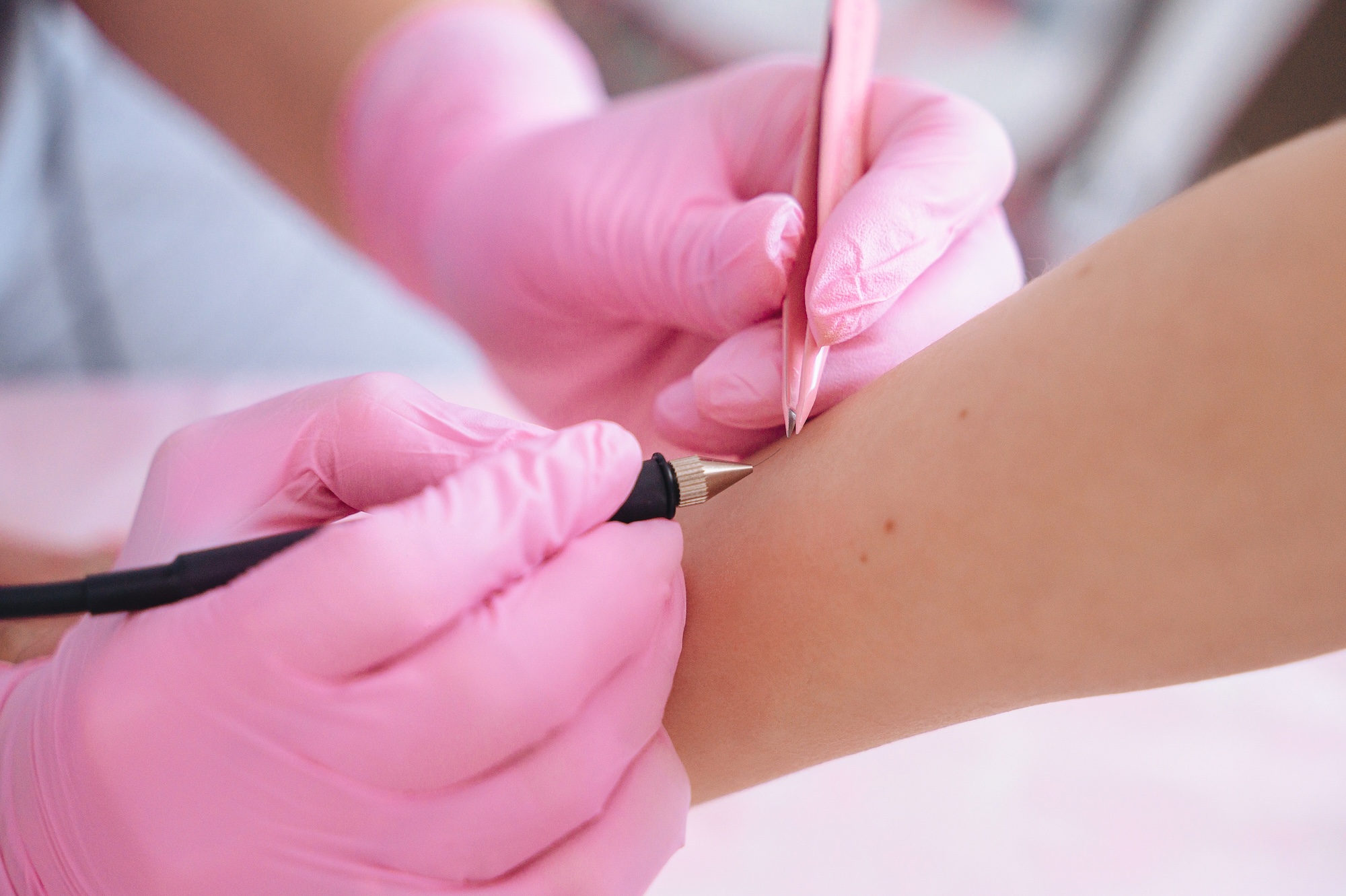 Electrolysis hair removal procedure in progress