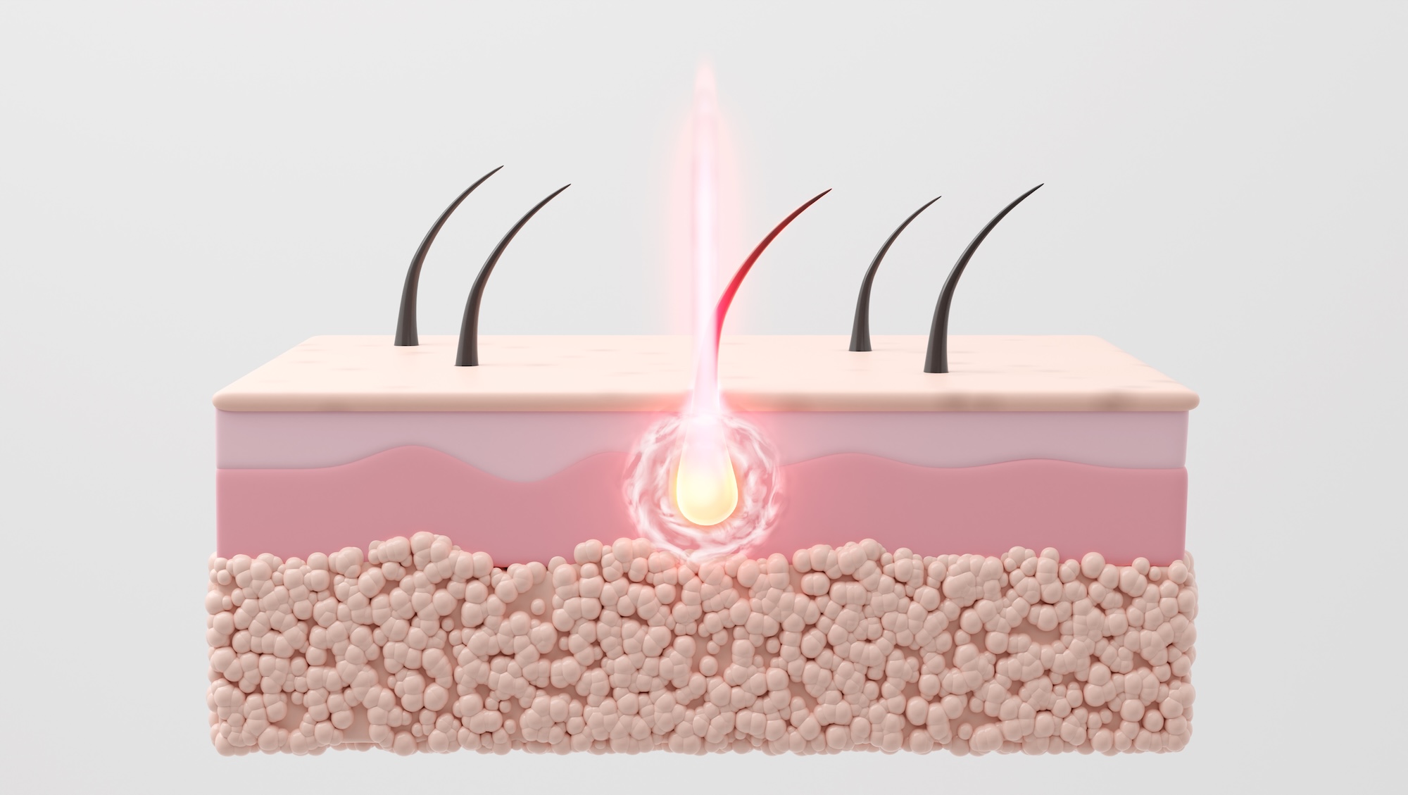 Laser burns hair roots, ensuring effective hair removal process. 3D rendering.
