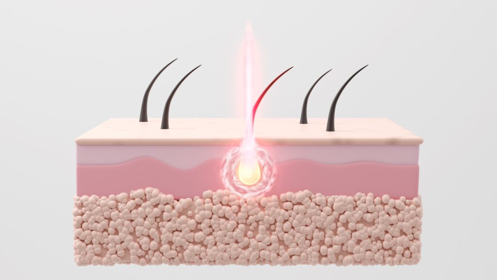 Laser burns hair roots, ensuring effective hair removal process. 3D rendering.