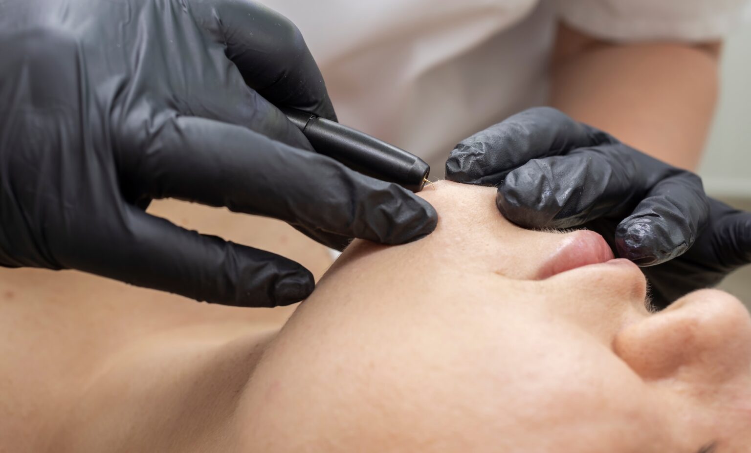 Electrolysis treatment on the chin for permanent hair removal of hormonal hair