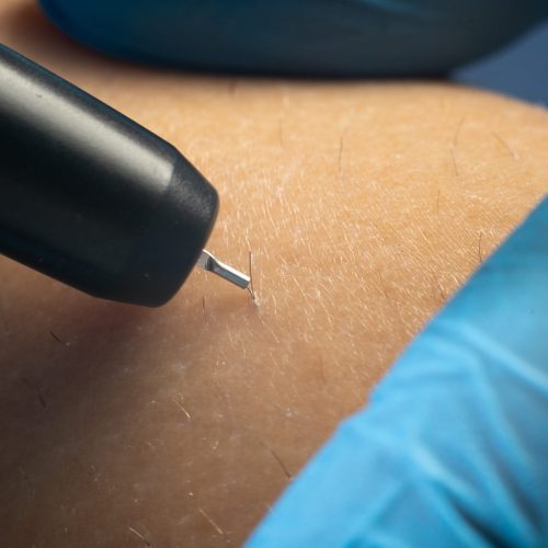 process of permanent hair removal, removing hair using an electroepilation device, close-up macro.