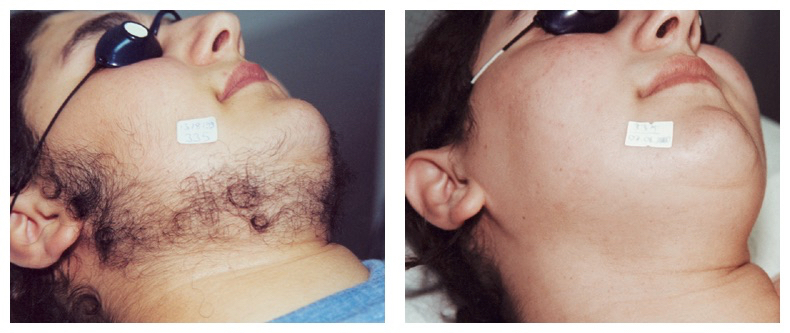 Neck hair before and after laser hair removal at Laser Affair in Tampa
