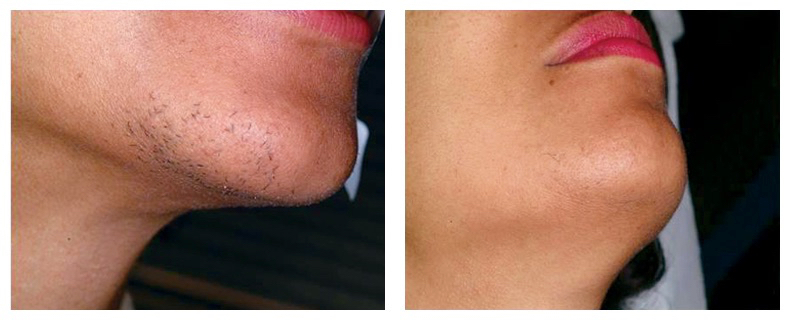 laser hair removal chin before and after