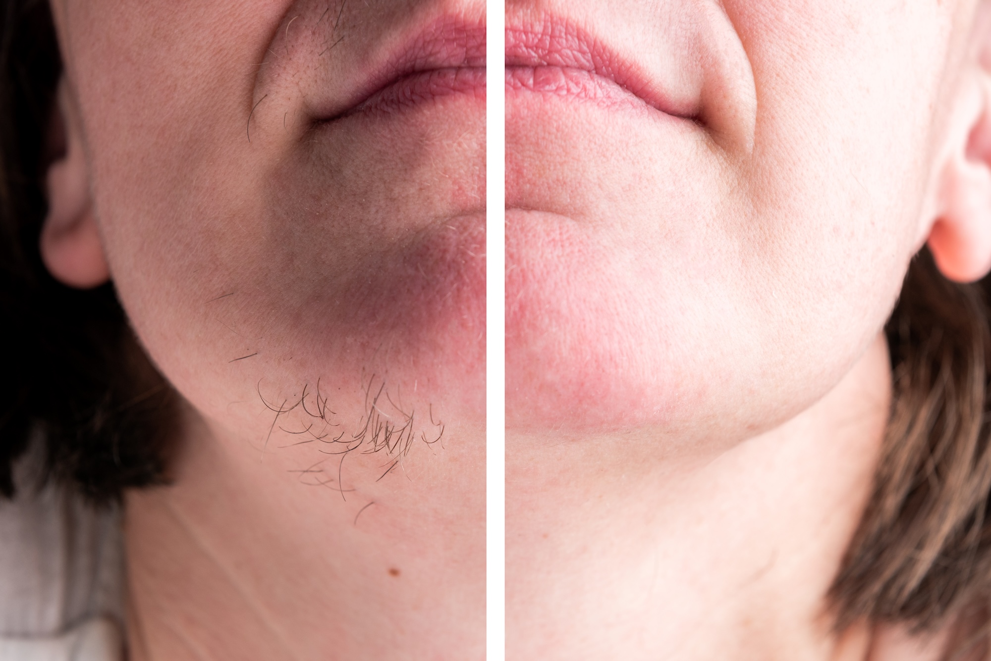 Before and after chin hair removal for PCOS-related growth at Laser Affair in Tampa