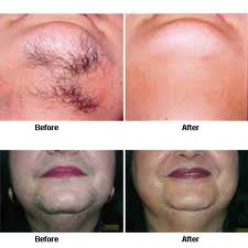 laser hair removal chin before and after