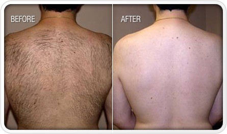 laser hair removal back before and after