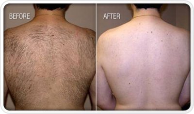 Before After Laser Hair Removal Photos Laser Affair