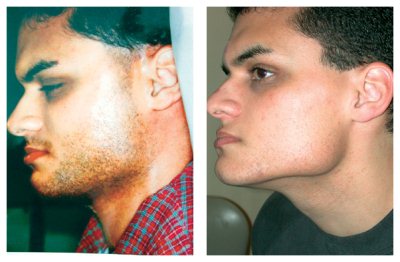 laser hair removal for men before and after