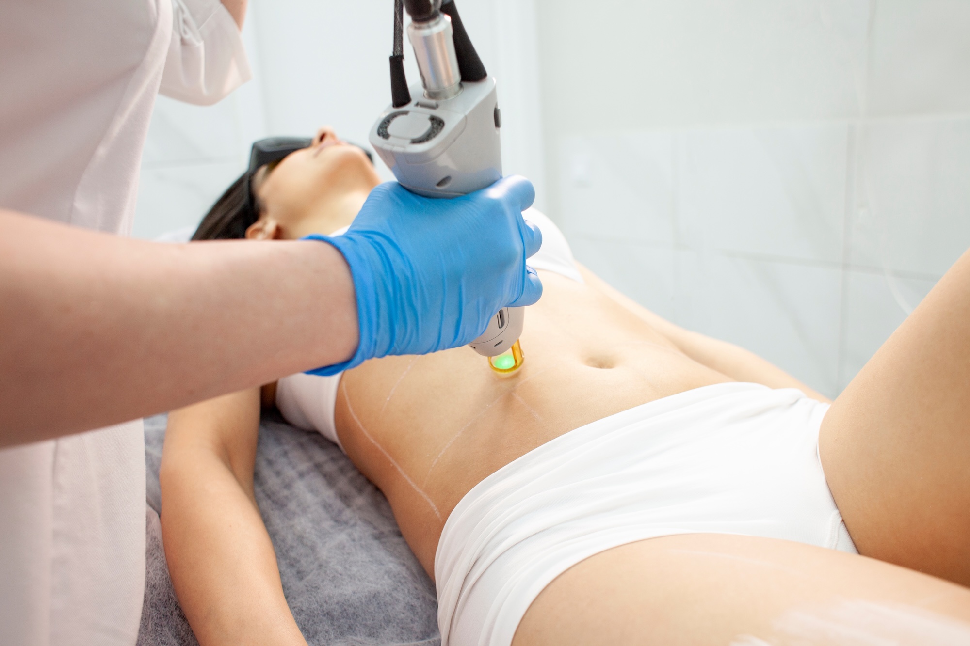 Shoulder laser hair removal at Laser Affair in Tampa