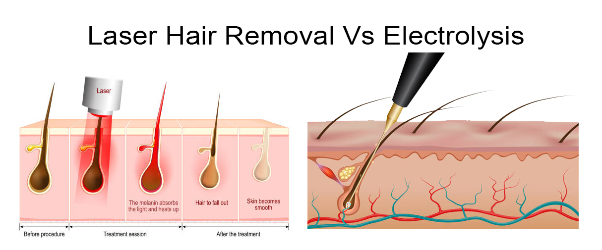 laser-hair-removal-vs-electrolysis