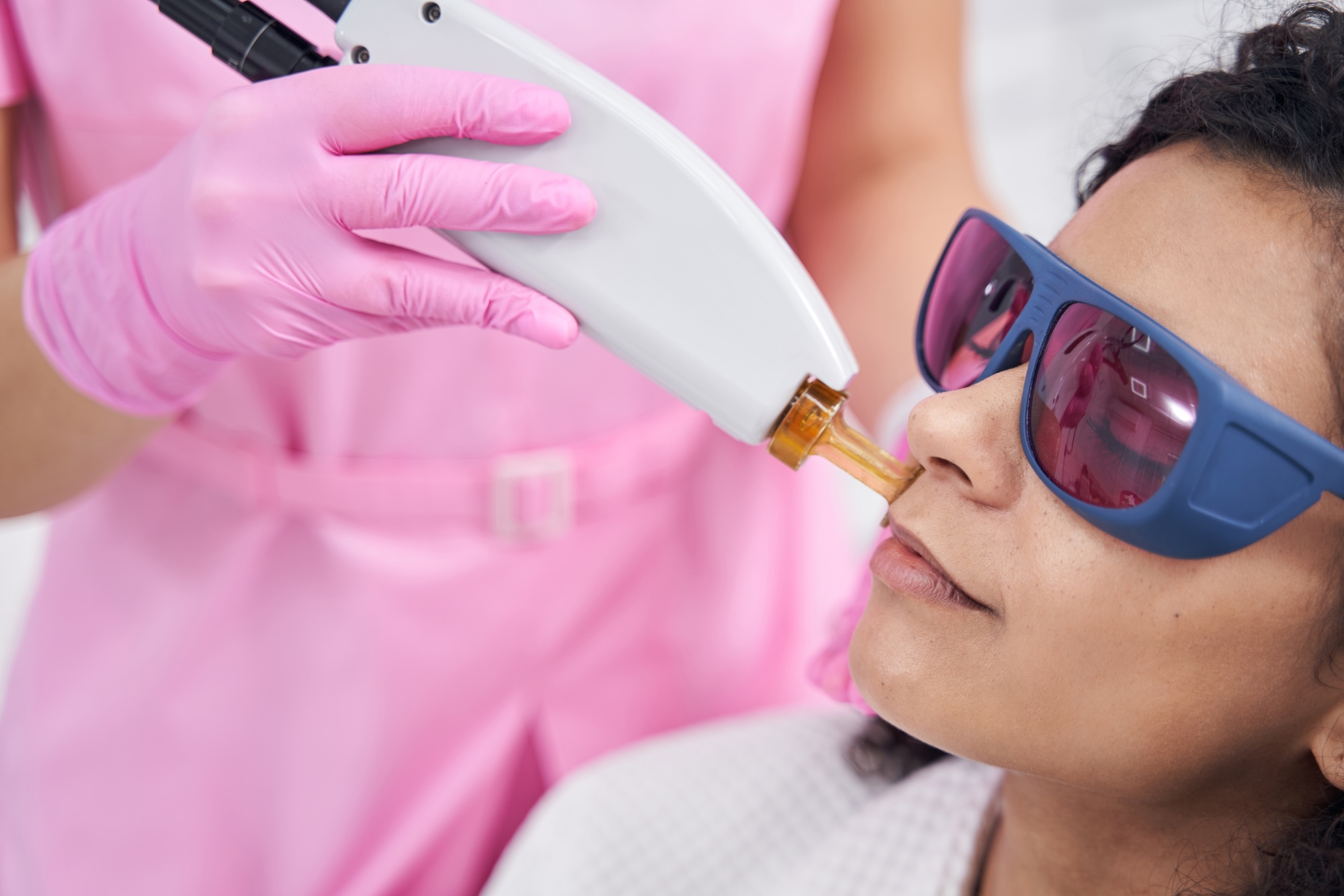 Upper lip laser hair removal for PCOS hair at Laser Affair in Tampa