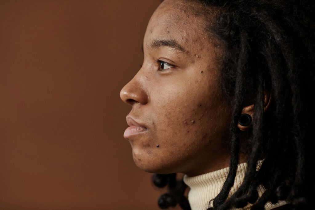hyperpigmentation scars
