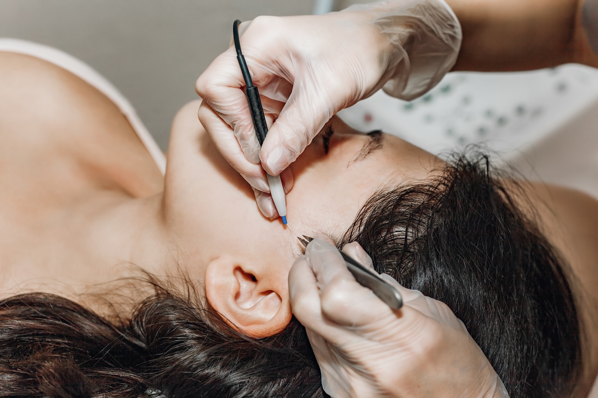 Sideburn electrolysis hair removal, a common area for hormonal hair growth in women