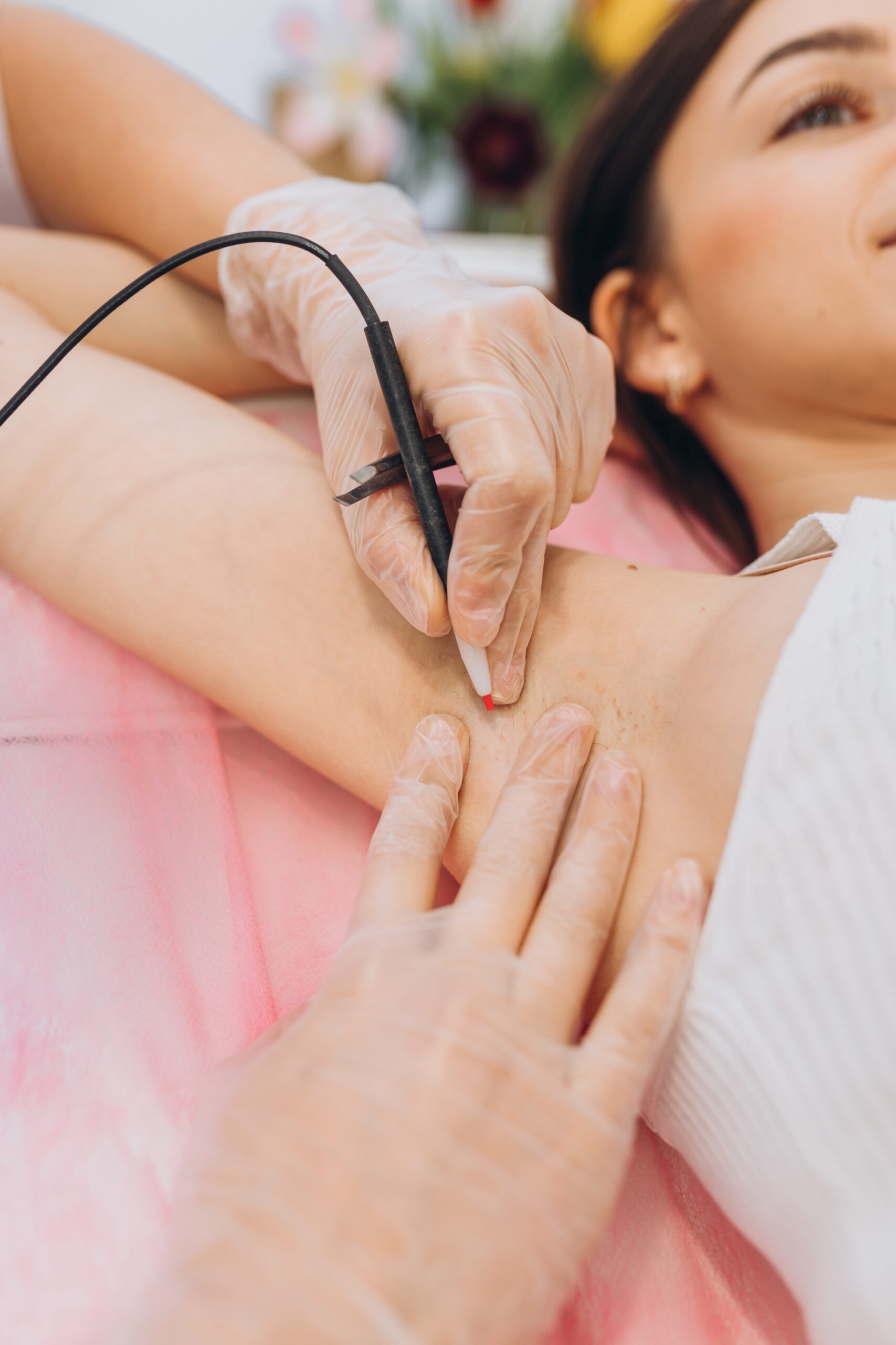 Procedure removal of hair permanently in a woman's armpits using metod electro epilation. Permanent removal of unwanted hair. The needle of electrolysis. Doctor in medical cabinet.