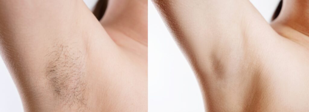 Woman with armpit hair, female hairy armpit, clean woman armpit, before and after laser hair removal